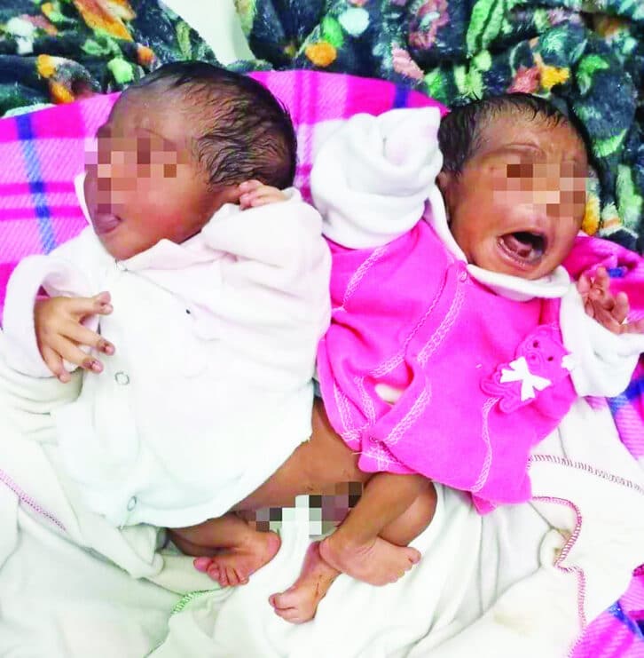 Image à la une de NAISSANCE – De nouveaux bébés siamois au CHUJRA